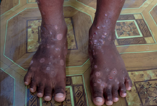 Haitian Health Ministry monitoring emergence of a 'very infectious' skin disease